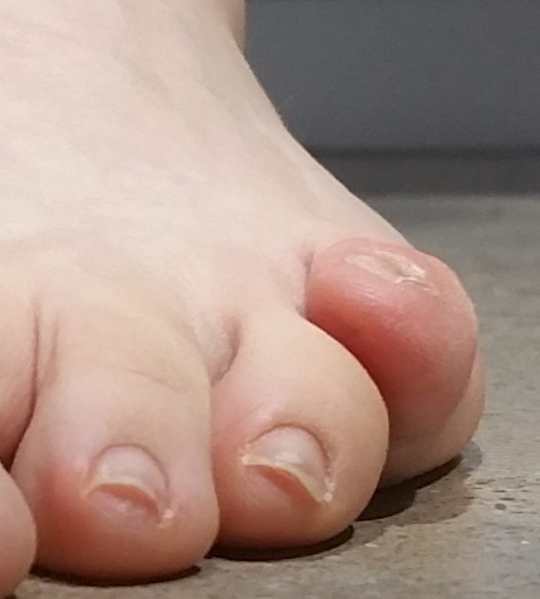 Cross-Over 5th Toe Correction