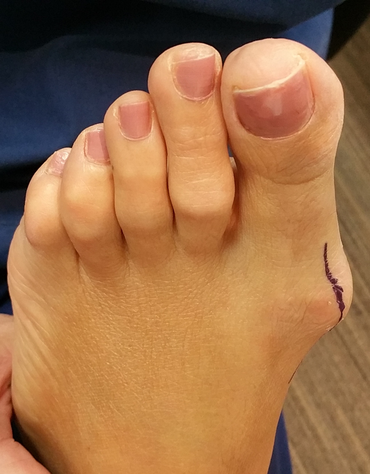 Surgical Correction of Bunions | Podiatric Surgery Centre