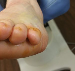 toe correction