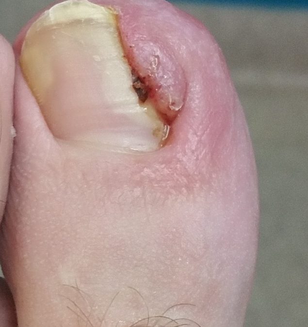 Ingrown Toenails