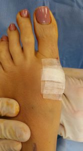painful bunions