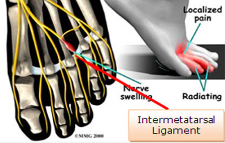 Neuroma-perineural-fibrosis.jpg