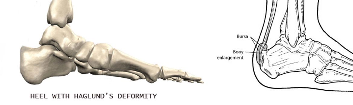haglunds-deformity-featured (1)